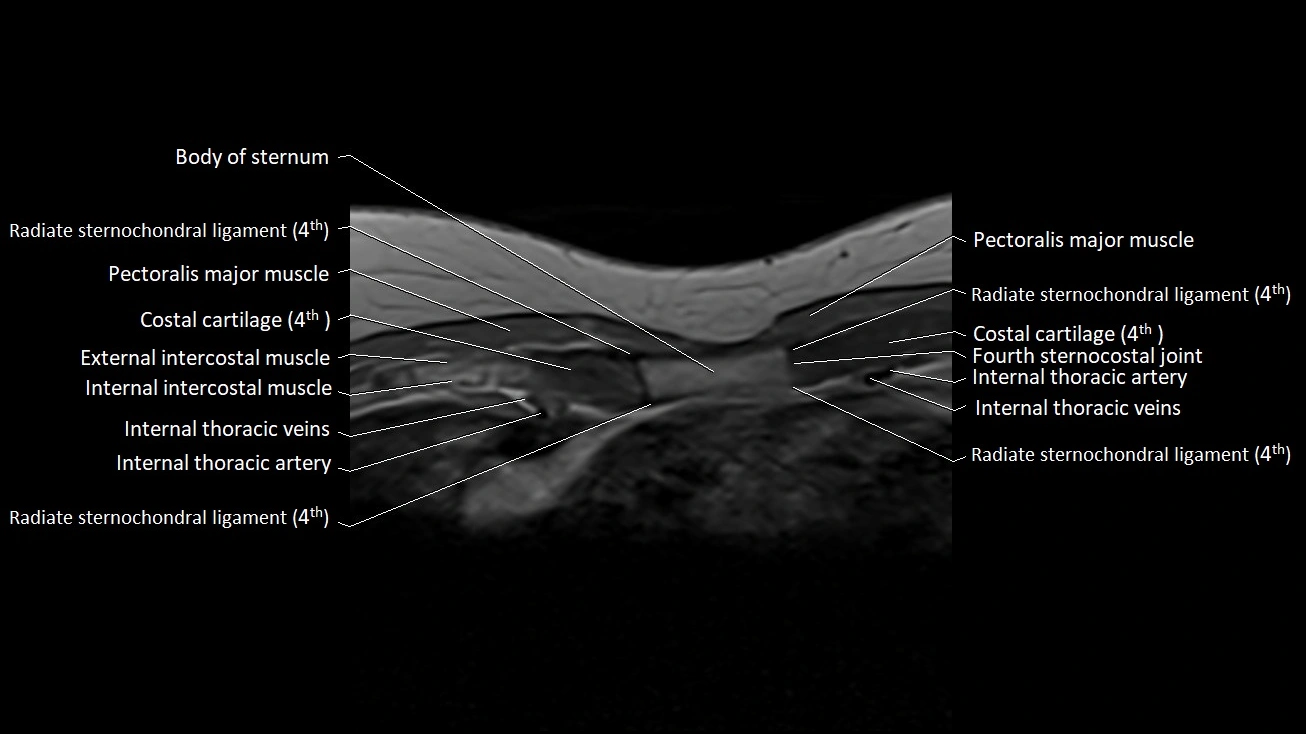 MRI sternum and sternoclavicular joint labeled axial anatomy image 24.webp